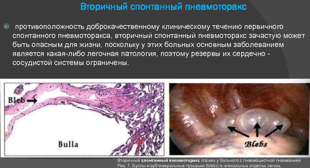 Вторичный спонтанный пневмоторакс противоположность доброкачественному клиническому течению первичного спонтанного пневмоторакса, вторичный спонтанный пневмоторакс зачастую