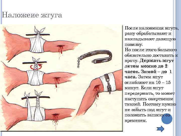 Наложеие жгуга После наложения жгута, рану обрабатывают и накладывают давящую повязку. Но после этого