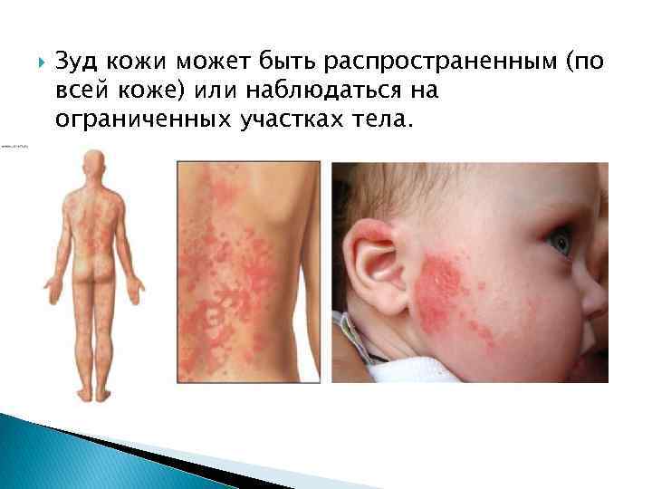  Зуд кожи может быть распространенным (по всей коже) или наблюдаться на ограниченных участках
