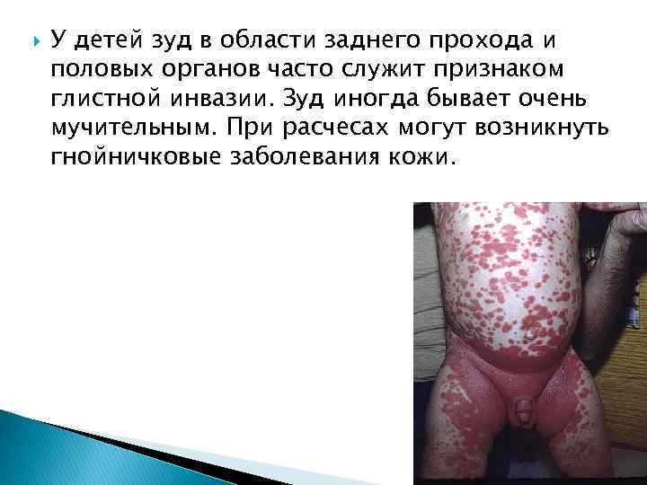  У детей зуд в области заднего прохода и половых органов часто служит признаком