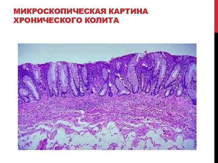 МИКРОСКОПИЧЕСКАЯ КАРТИНА ХРОНИЧЕСКОГО КОЛИТА 