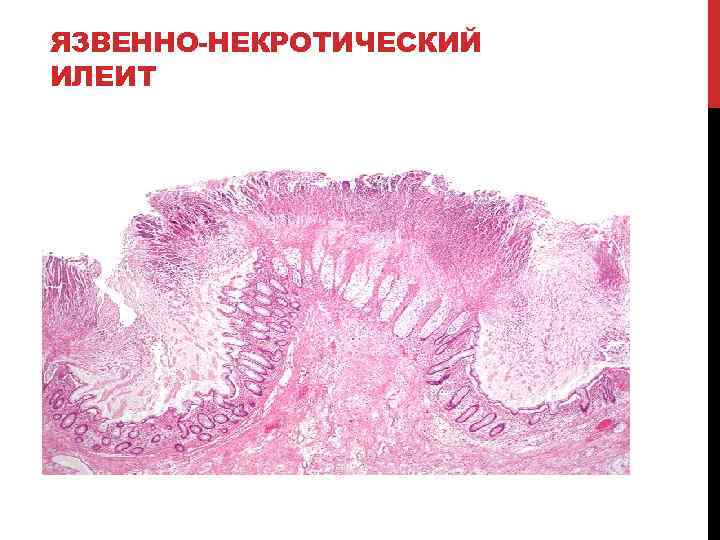 Язва микропрепарат. Язвенно некротический энтерит. Некротический гастрит гистология. Язвенный колит гистология. Язвенный колит микропрепарат.