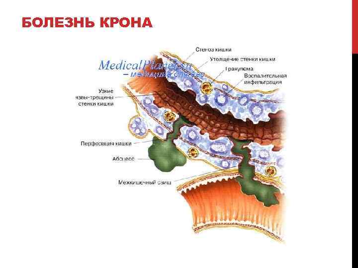 БОЛЕЗНЬ КРОНА 