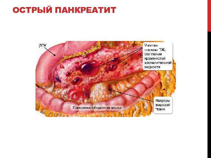 ОСТРЫЙ ПАНКРЕАТИТ 