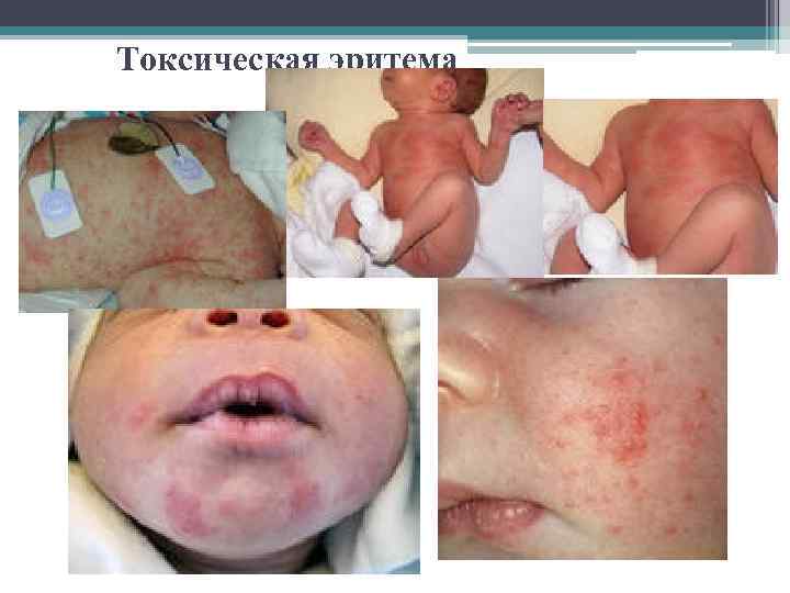 Токсическая эритема 