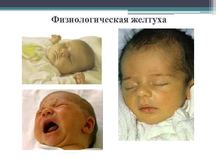 Физиологическая желтуха 