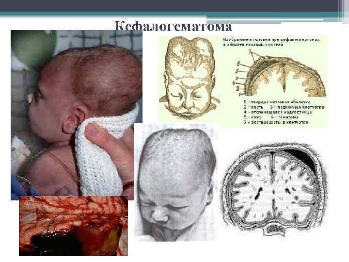 Кефалогематома 