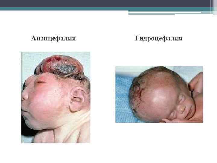 Анэнцефалия Гидроцефалия 