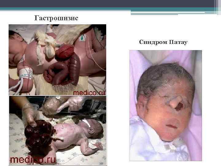 Гастрошизис Синдром Патау 