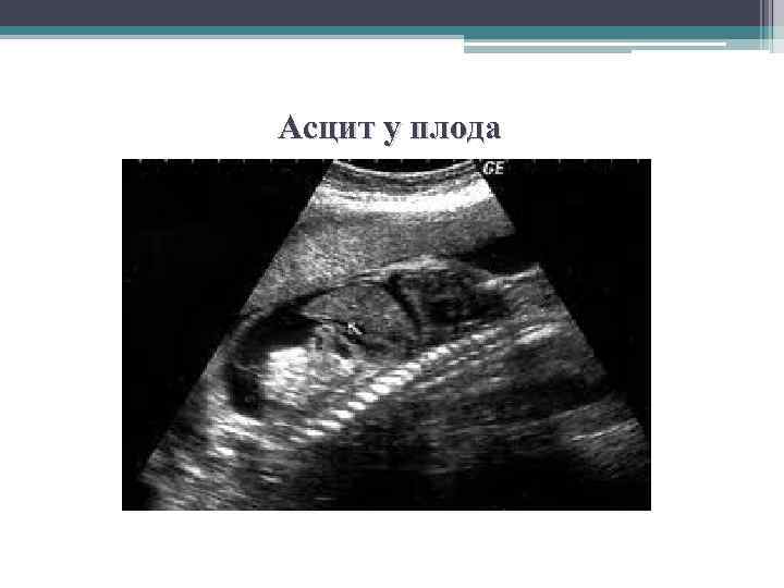 Асцит у плода 