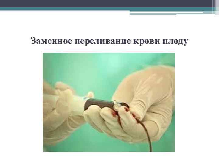 Заменное переливание крови плоду 