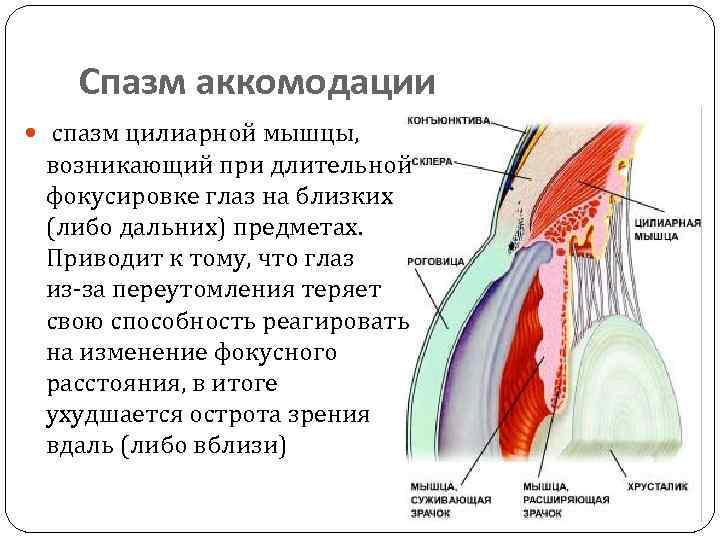 Спазм аккомодации спазм цилиарной мышцы, возникающий при длительной фокусировке глаз на близких (либо дальних)