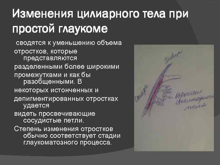 Изменения цилиарного тела при простой глаукоме сводятся к уменьшению объема отростков, которые представляются разделенными