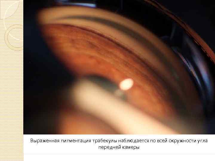 Выраженная пигментация трабекулы наблюдается по всей окружности угла передней камеры 