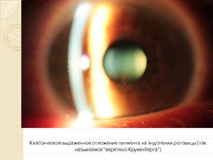 Классическое выраженное отложение пигмента на эндотелии роговицы (так называемое 