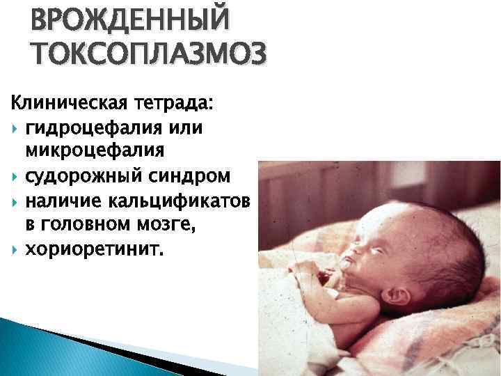 ВРОЖДЕННЫЙ ТОКСОПЛАЗМОЗ Клиническая тетрада: гидроцефалия или микроцефалия судорожный синдром наличие кальцификатов в головном мозге,