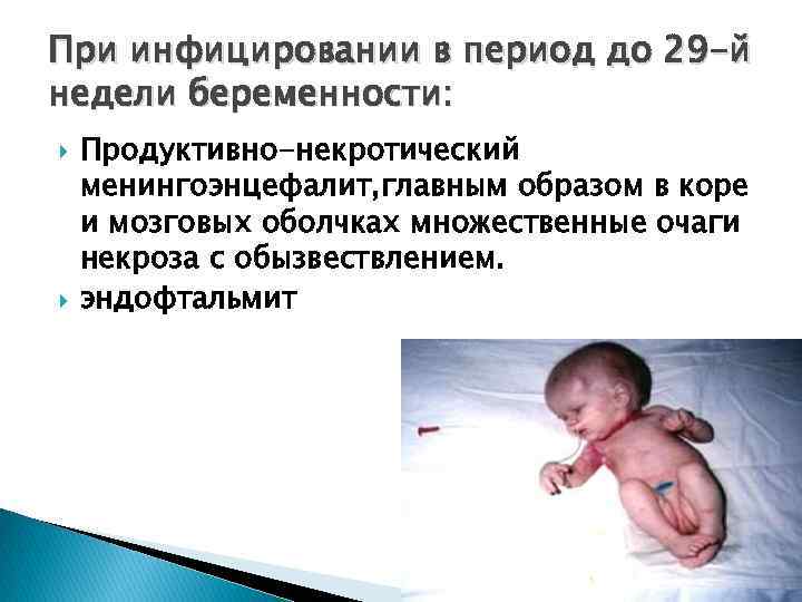 При инфицировании в период до 29 -й недели беременности: Продуктивно-некротический менингоэнцефалит, главным образом в