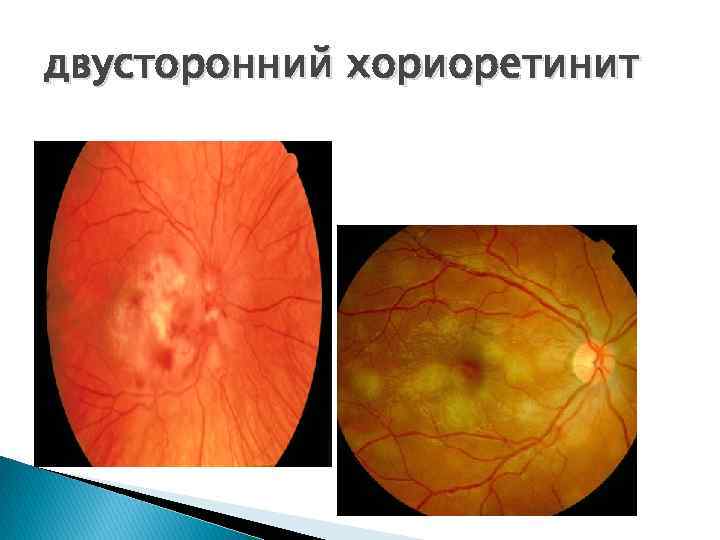 двусторонний хориоретинит 