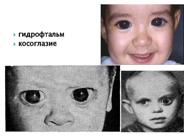  гидрофтальм косоглазие 