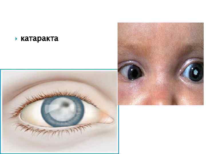  катаракта 