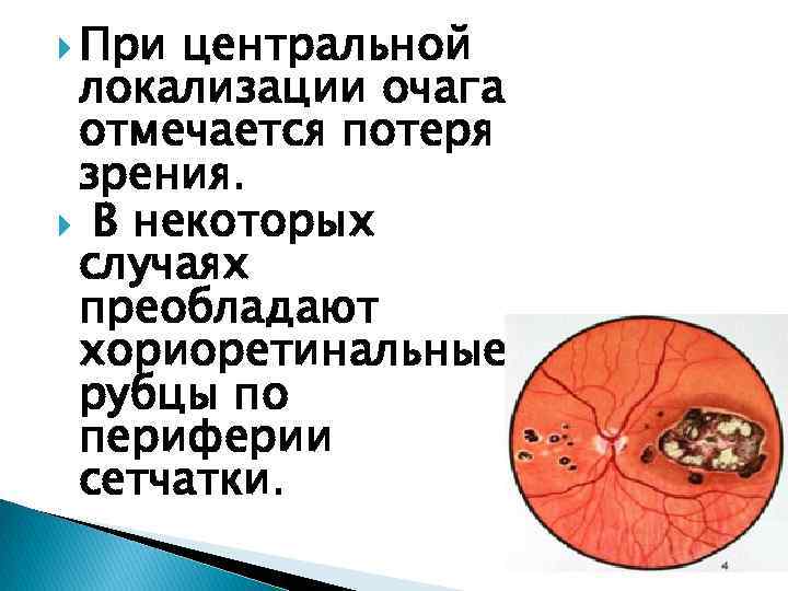  При центральной локализации очага отмечается потеря зрения. В некоторых случаях преобладают хориоретинальные рубцы