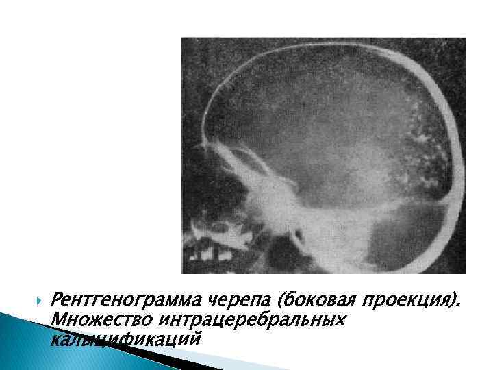  Рентгенограмма черепа (боковая проекция). Множество интрацеребральных калыцификаций 