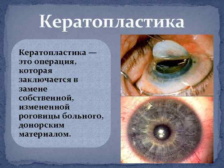 Кератопластика — это операция, которая заключается в замене собственной, измененной роговицы больного, донорским материалом.