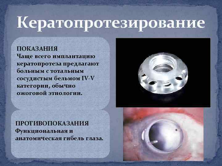 Кератопротезирование ПОКАЗАНИЯ Чаще всего имплантацию кератопротеза предлагают больным с тотальным сосудистым бельмом IV V