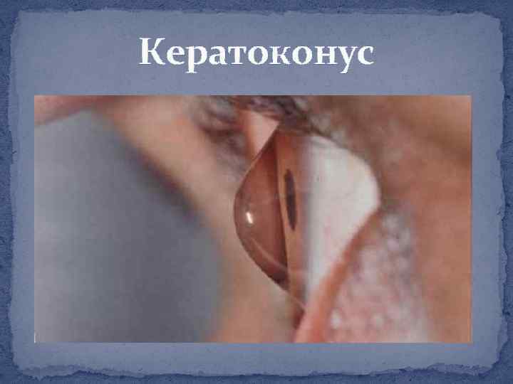 Кератоконус 