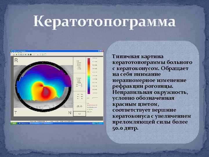 Кератотопограмма Типичная картина кератотопограммы больного с кератоконусом. Обращает на себя внимание неравномерное изменение рефракции