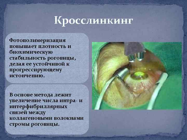 Кросслинкинг Фотополимеризация повышает плотность и биохимическую стабильность роговицы, делая ее устойчивой к прогрессирующему истончению.
