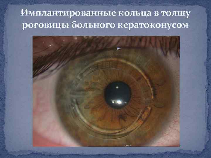 Имплантированные кольца в толщу роговицы больного кератоконусом 