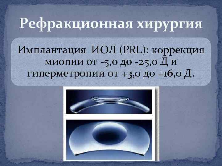Рефракционная хирургия Имплантация ИОЛ (PRL): коррекция миопии от -5, 0 до -25, 0 Д