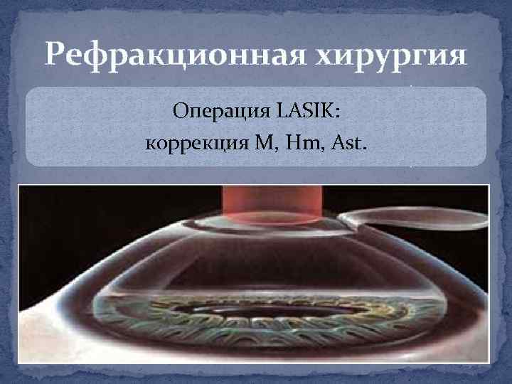Рефракционная хирургия Операция LASIK: коррекция М, Hm, Ast. 