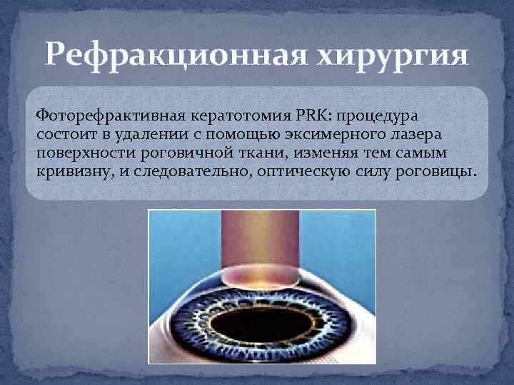 Рефракционная хирургия Фоторефрактивная кератотомия PRK: процедура состоит в удалении с помощью эксимерного лазера поверхности