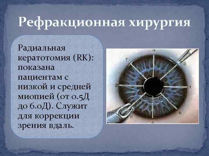 Рефракционная хирургия Радиальная кератотомия (RK): показана пациентам с низкой и средней миопией (от 0.