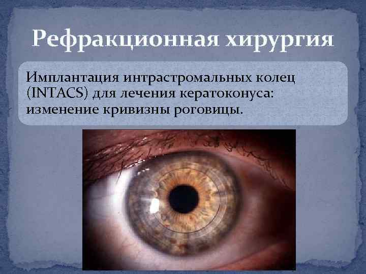 Рефракционная хирургия Имплантация интрастромальных колец (INTACS) для лечения кератоконуса: изменение кривизны роговицы. 
