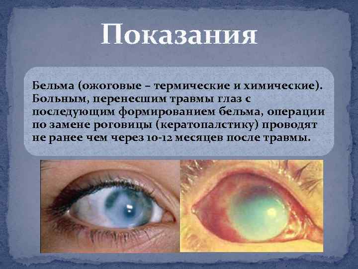 Показания Бельма (ожоговые – термические и химические). Больным, перенесшим травмы глаз с последующим формированием