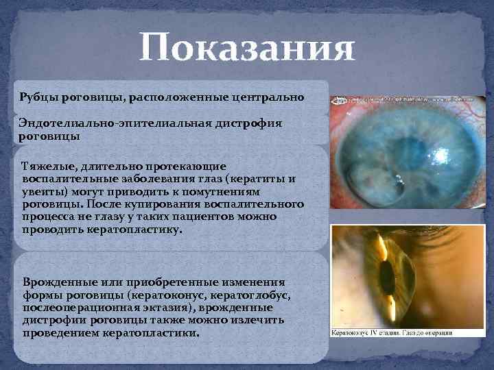 Показания Рубцы роговицы, расположенные центрально Эндотелиально эпителиальная дистрофия роговицы Тяжелые, длительно протекающие воспалительные заболевания