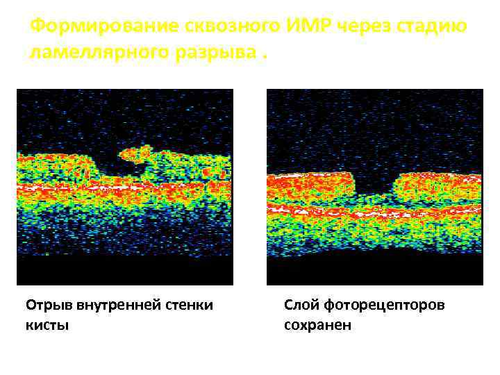 Формирование сквозного ИМР через стадию ламеллярного разрыва. Отрыв внутренней стенки кисты Слой фоторецепторов сохранен