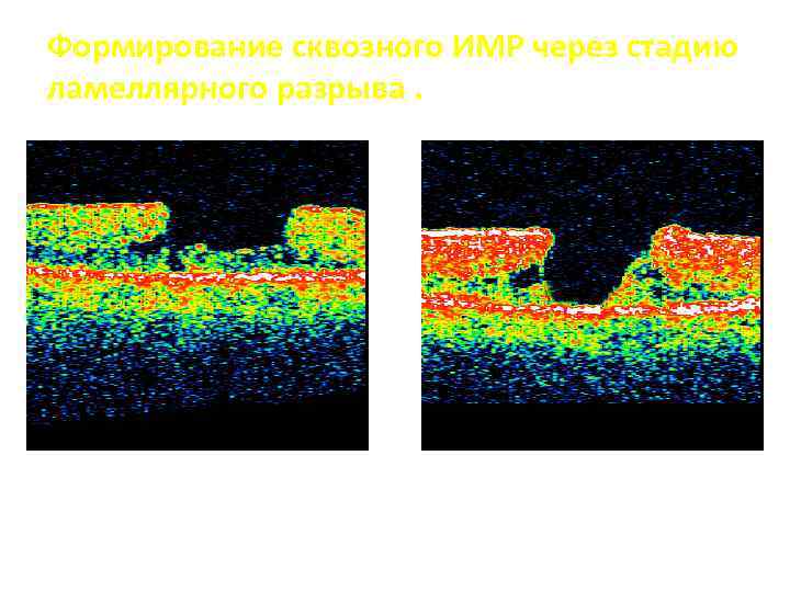 Формирование сквозного ИМР через стадию ламеллярного разрыва. Истончение слоя фоторецепторов Дефект сетчатки на всю