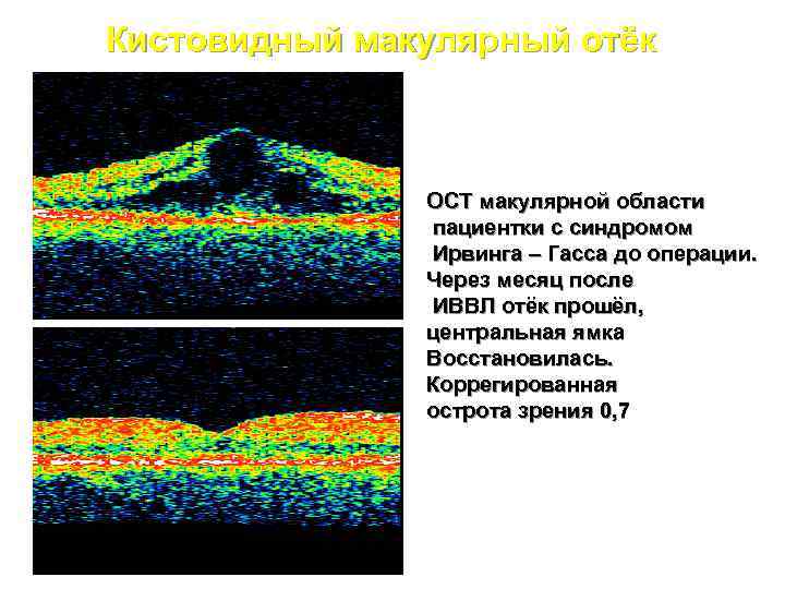 Кистовидный макулярный отёк ОСТ макулярной области пациентки с синдромом Ирвинга – Гасса до операции.