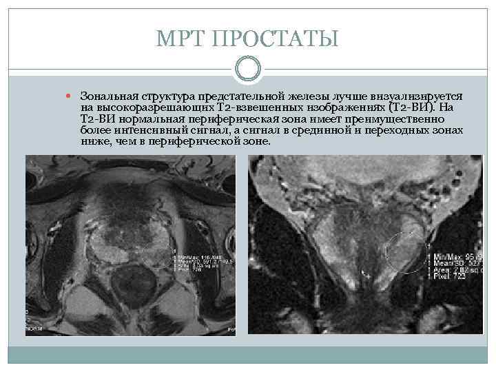 МРТ ПРОСТАТЫ Зональная структура предстательной железы лучше визуализируется на высокоразрешающих Т 2 -взвешенных изображениях