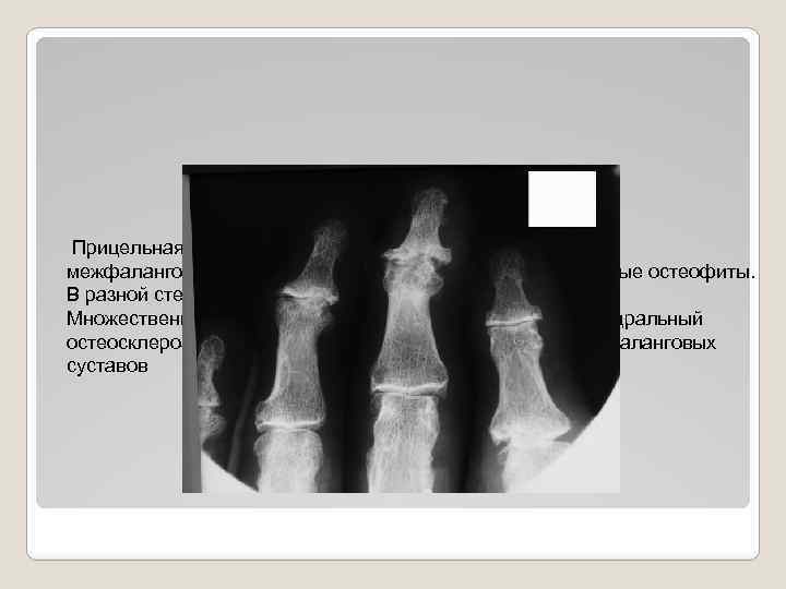 Прицельная рентгенография проксимальных и дистальных межфаланговых суставов в прямой проекции. Множественные остеофиты. В разной