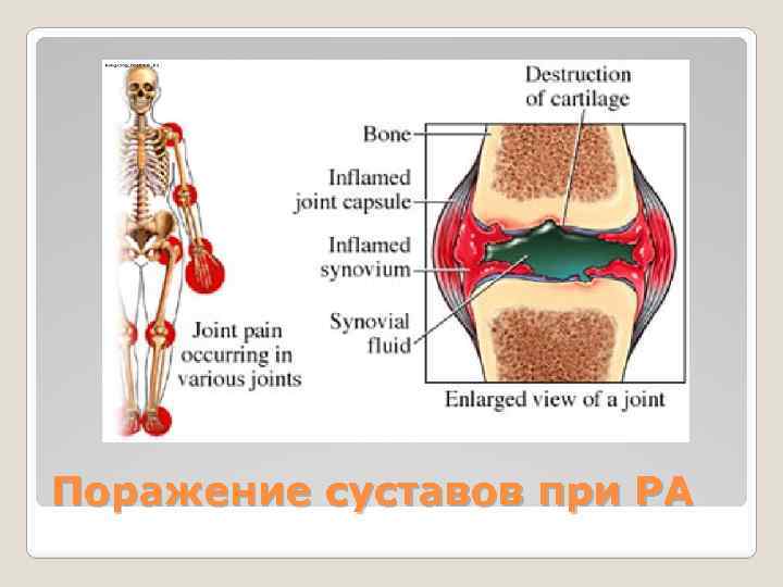 Поражение суставов при РА 