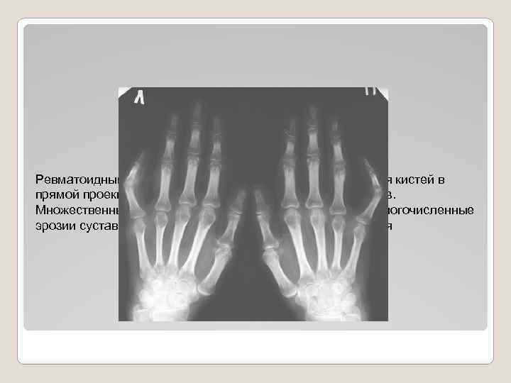Ревматоидный артрит, стадия 2. Обзорная рентгенография кистей в прямой проекции. Выраженный околосуставной остеопороз. Множественные