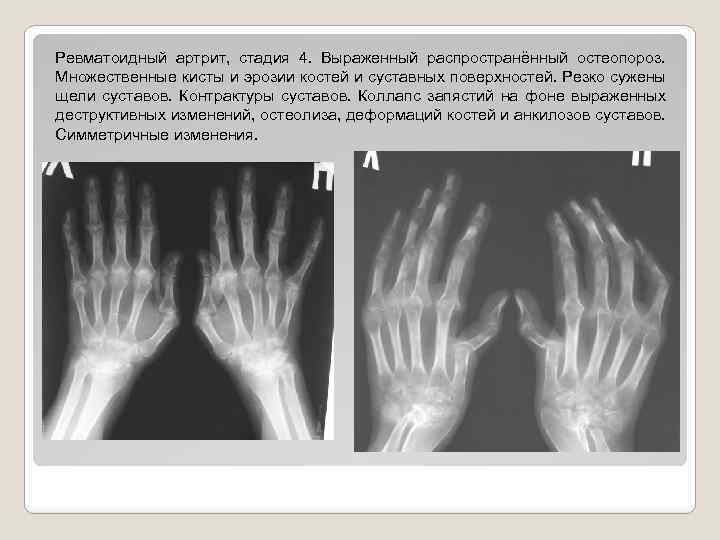 Ревматоидный артрит, стадия 4. Выраженный распространённый остеопороз. Множественные кисты и эрозии костей и суставных