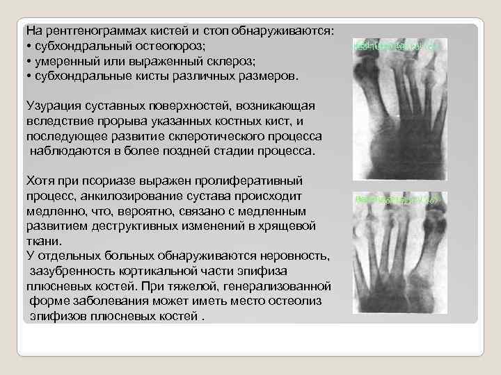 На рентгенограммах кистей и стоп обнаруживаются: • субхондральный остеопороз; • умеренный или выраженный склероз;