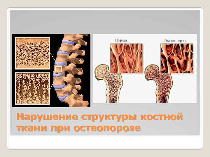 Нарушение структуры костной ткани при остеопорозе 