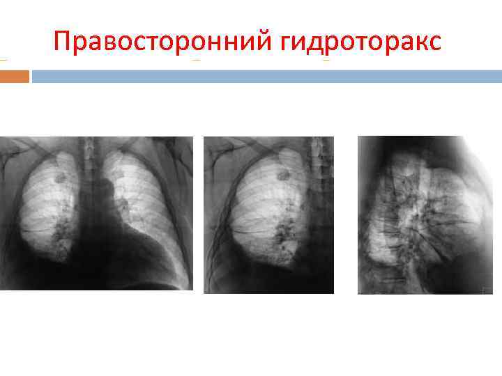  Правосторонний гидроторакс 